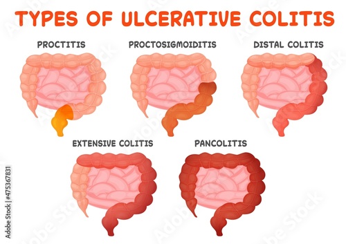 Ulcerative colitis types, gut disease, intestine inflammation from proctitis to pancolitis. Medical vector illustration photo