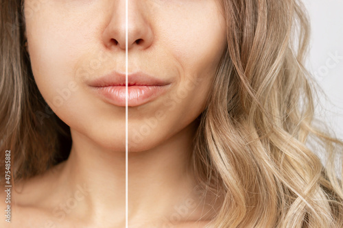 Cropped shot of young caucasian blonde woman with wavy hair before and after plastic surgery buccal fat pad removal. A lower part of face with clear highlighted cheekbones. Result of cosmetic surgery photo