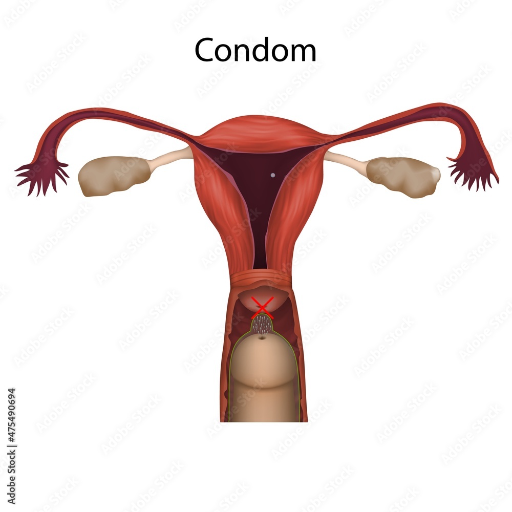 Condom contraception mechanism action, illustration Condom contraception mechanism action, illustration