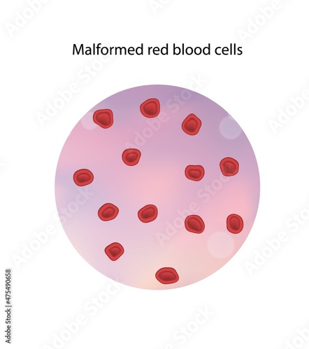 Malformed red blood cells, illustration photo