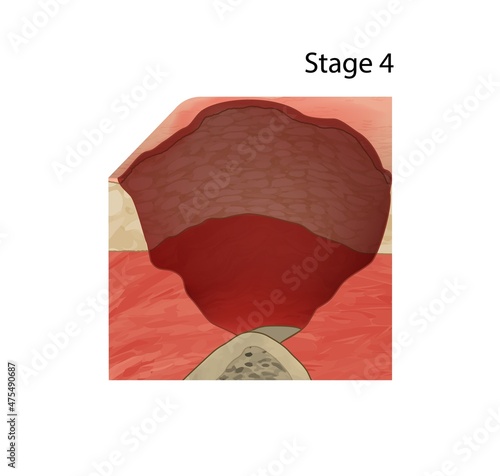 Stage 4 pressure sore, illustration photo