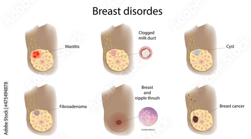 Female breast disorders, illustration