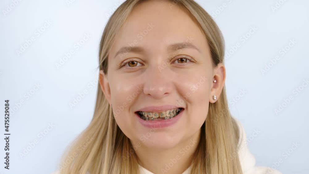 Young happy woman smile with dental braces. Beautiful smiling girl with brackets for teeth. Smiling female. Braces mouth. Young happy woman smile with dental braces. Beautiful smiling girl with brackets for teeth. Smiling female. Braces mouth.