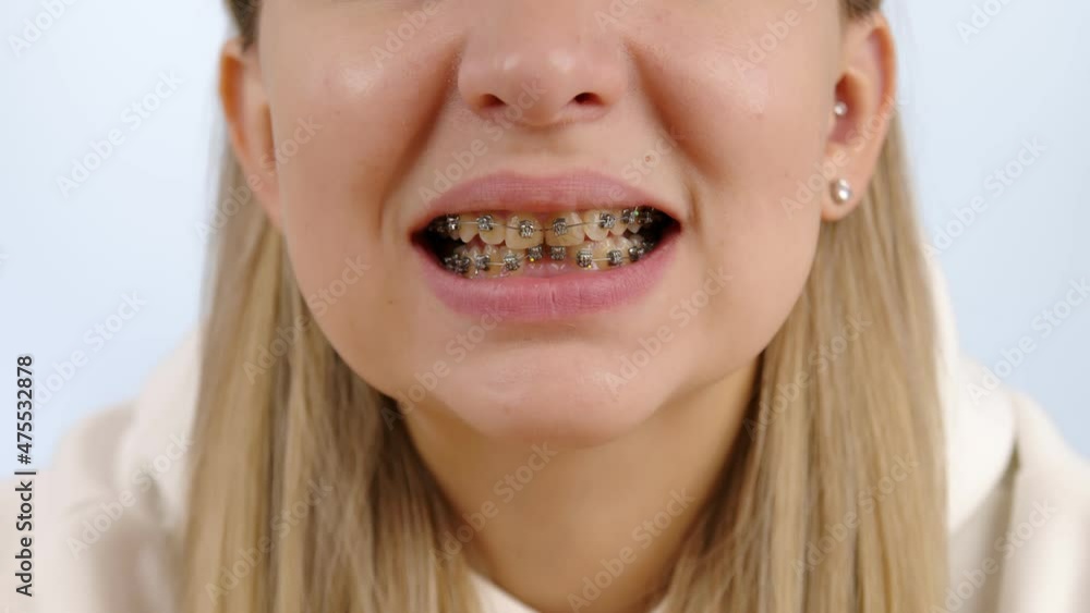 Beautiful smiling girl with brackets for teeth. Close-up of female teeth with metal braces. Beautiful smiling girl with brackets for teeth. Close-up of female teeth with metal braces.