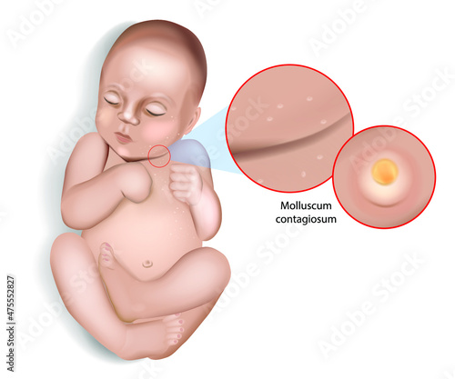 Molluscum contagiosum virus infection. Water warts. Molluscum contagiosum virus on the skin of an infant