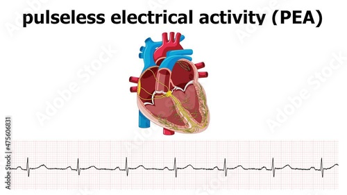 heart animation pulseless electrical activity (PEA) with ecg photo