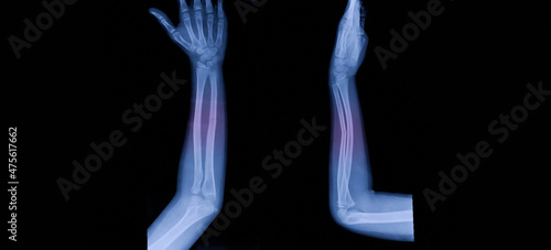 A photo of plain radiograph on dark background in hospital. The film use for diagnosis the illness of patient.Medical concept. A children with fracture distal ulnar bone. A green stick fracture. photo