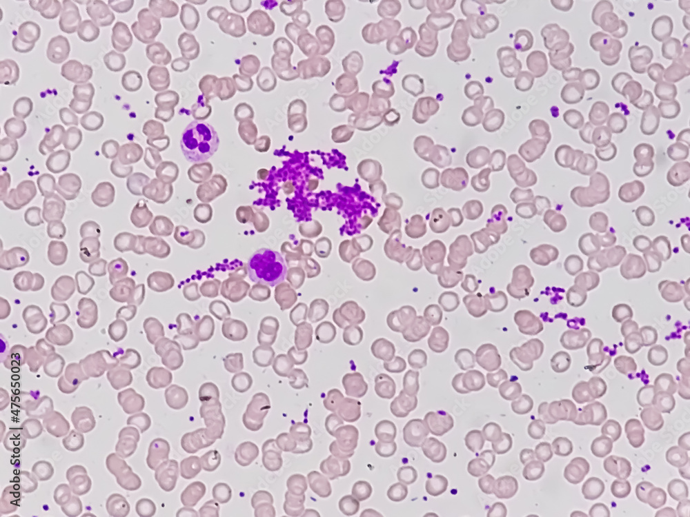 Giant platelet disorders are rare disorders featuring abnormally large
