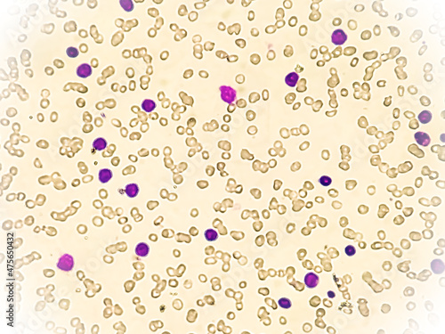 Leuco-erythroblastic anaemia and Chronic myelomonocytic leukemia (CMML), MPD, Blood smear under microscope photo