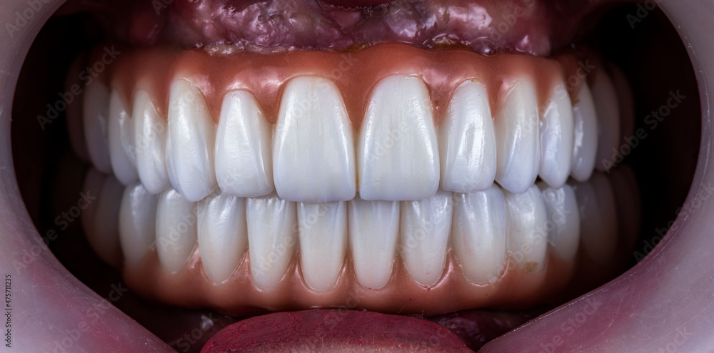 zirkon ceramic crowns on implants zirkon ceramic crowns on implants