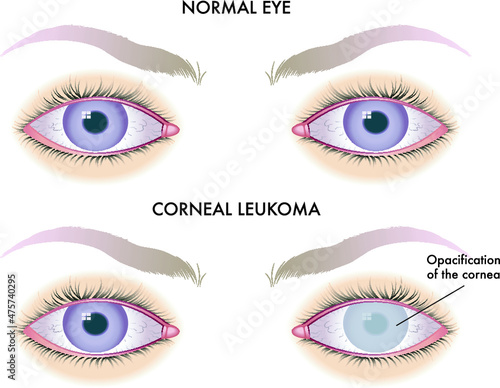 Medical illustration of one of the possible consequences of corneal leucoma on the eye.
