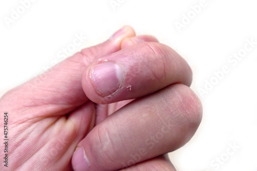 Εκτύπωση καμβά skin peeling on finger nails, vitamin C deficiency and nail skin diseases,