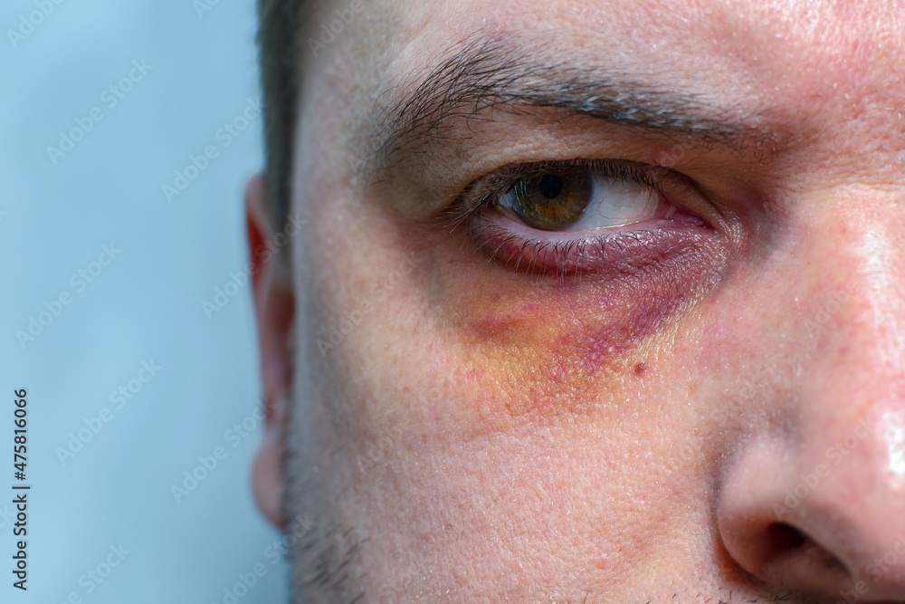 Obraz premium A man with a black eye, after a fight or an accident.Eye injury