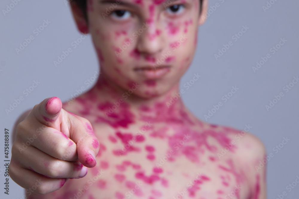 Have you ever had chickenpox? An eight-year-old boy points his finger ...