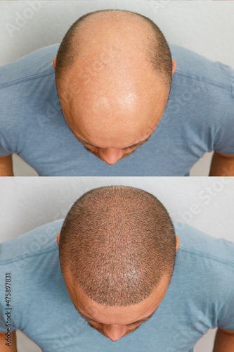 Canvastavla The head of a balding man before and after hair transplant surgery