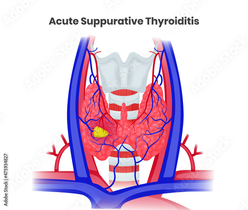 Acute suppurative thyroiditis vector illustration. Illustration of the bacterial thyroid abscess