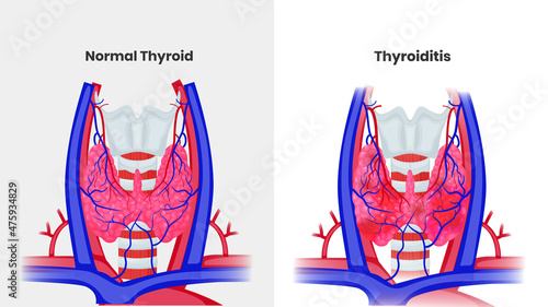 Normal thyroid anatomy vs thyroiditis. Illustration of the normal thyroid structure and inflamed thyroid