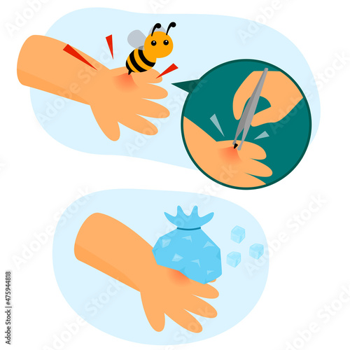 bee sting firs aid