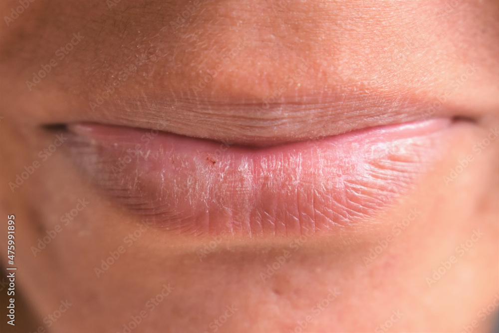 Closeup of female dry and cracked lips, skin care concept Closeup of female dry and cracked lips, skin care concept
