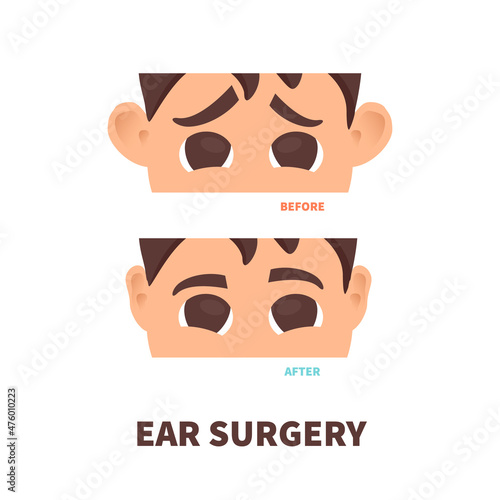 Cosmetic facial plastic ear surgery for men. Before and after otoplasty surgical correction procedure. Pinnaplasty ear pinning reshaping design template. Medical vector illustration.