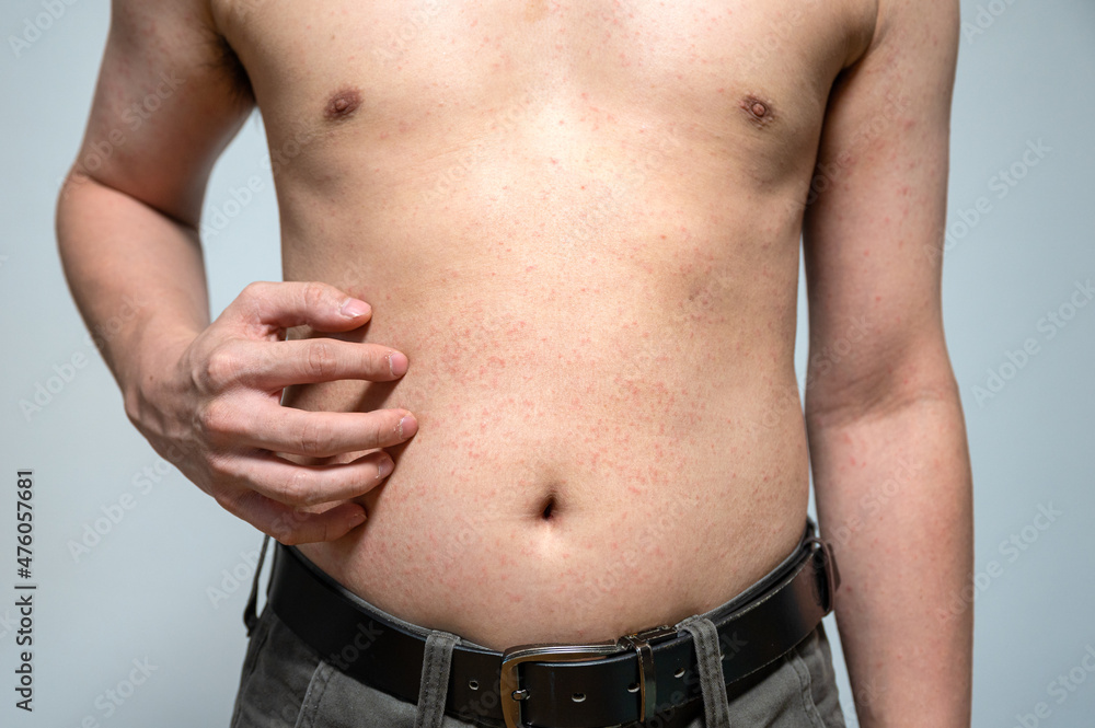 Naklejka premium Dermatitis rash viral disease with immunodeficiency on body of young adult asian, scratching with itching