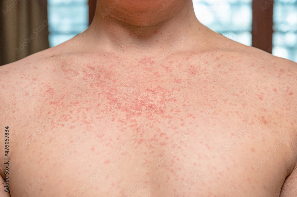 Dermatitis rash viral disease with immunodeficiency on body of young adult asian, scratch with