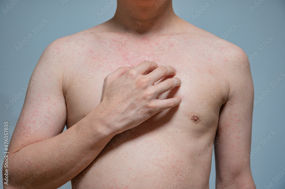 Dermatitis rash viral disease with immunodeficiency on body of young adult asian, scratching with itching Dermatitis rash viral disease with immunodeficiency on body of young adult asian, scratching with itching