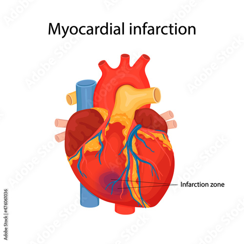 Myocardial infarction. illustration of a human heart. Heart attack. cartoon style illustration