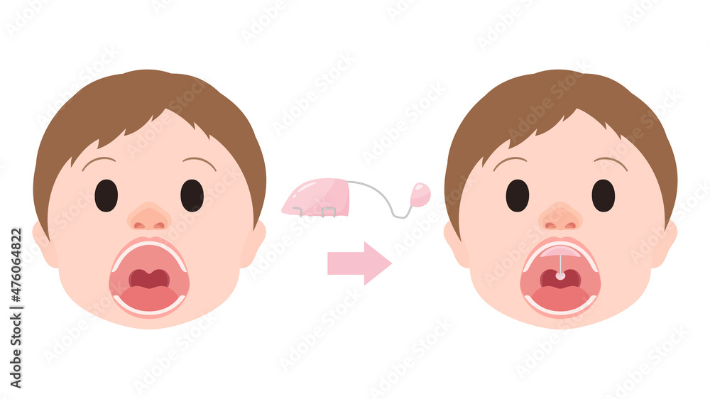 口唇口蓋裂_バルブ型スピーチエイドを装着するイラスト_構音障害 Stock Vector Adobe Stock