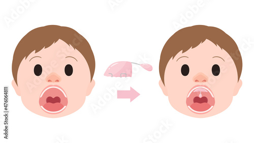 口唇口蓋裂_パラタルリフトを装着するイラスト_軟口蓋挙上装置