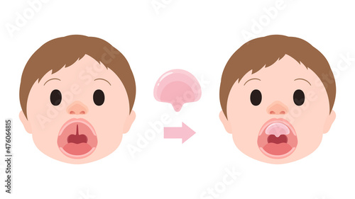 口唇口蓋裂_ホッツ床を装着するイラスト_Hotz床_NAM無し