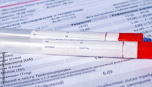 Test tubes and results of biochemical tests for viruses  photo