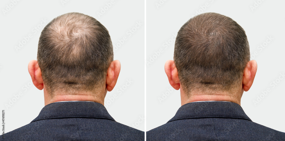 The head of a balding man before and after hair transplant surgery. A man  losing his hair has become shaggy. An advertising poster for a hair  transplant clinic. Treatment of baldness. Stock