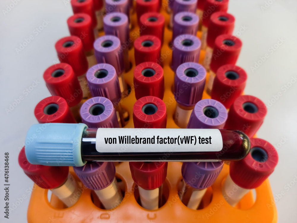 Blood sample for von Willebrand factor(vWF) antigen test, clotting Blood sample for von Willebrand factor(vWF) antigen test, clotting