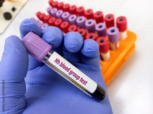 Scientist hold blood sample for Bombay blood grouping, Hh blood grouping test, laboratory background