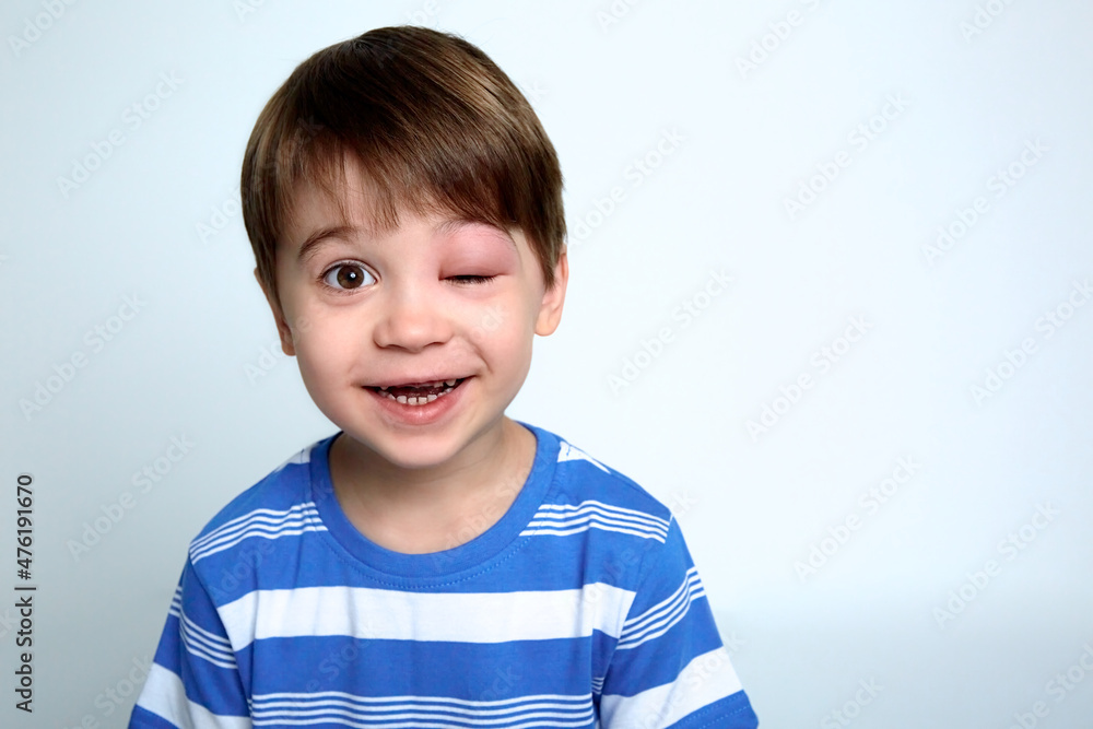A boy with swollen eye from insect bite. Quincke edema. Close-up. Portrait of European appearance child looking at the camera and laughs. Studio background. Isolated. Face of allergic person. Allergy A boy with swollen eye from insect bite. Quincke edema. Close-up. Portrait of European appearance child looking at the camera and laughs. Studio background. Isolated. Face of allergic person. Allergy