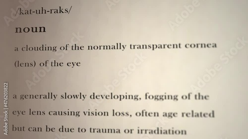 Cataracts Definition photo