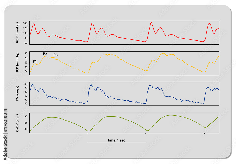 Naklejka premium Intracranial Pressure Monitoring ICP waveform, 3d render, 2d graphic