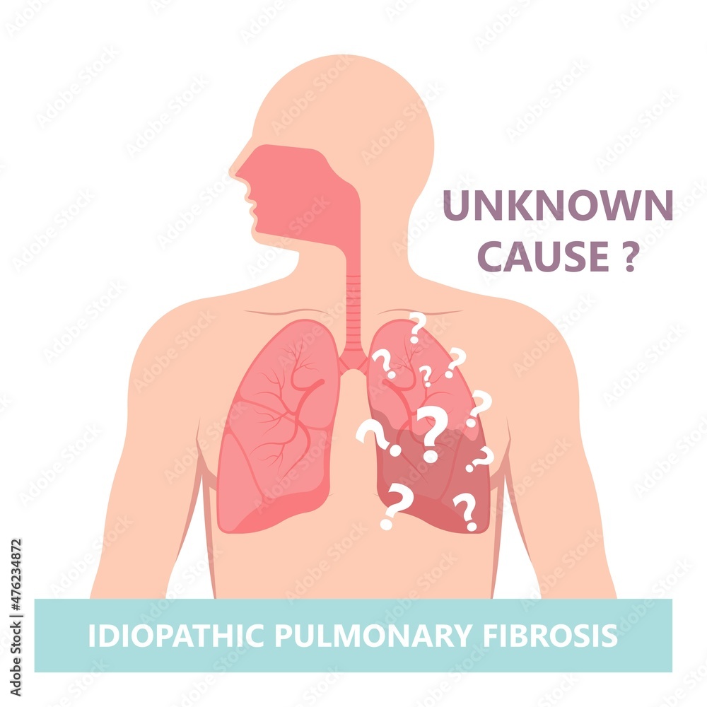 Capillary dry cough of wood metal dust breath virus Chest Xray Cancer