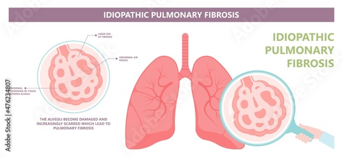 Capillary dry cough of wood metal dust breath virus Chest X-ray Cancer scan High resolution HRCT Biopsy usual COPD chronic asbestos corona covid 19 cystic diagnose disorder dyspnea fibers ILD UIP IPF