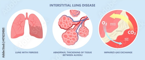 Capillary dry cough of wood metal dust breath virus Chest X-ray Cancer scan High resolution HRCT Biopsy usual COPD chronic asbestos corona covid 19 cystic diagnose disorder dyspnea fibers ILD UIP IPF photo