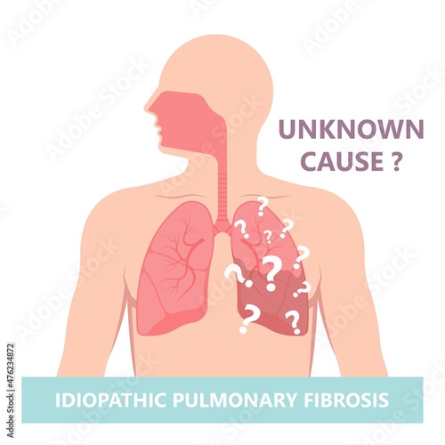 Capillary dry cough of wood metal dust breath virus Chest X-ray Cancer scan High resolution HRCT Biopsy usual COPD chronic asbestos corona covid 19 cystic diagnose disorder dyspnea fibers ILD UIP IPF