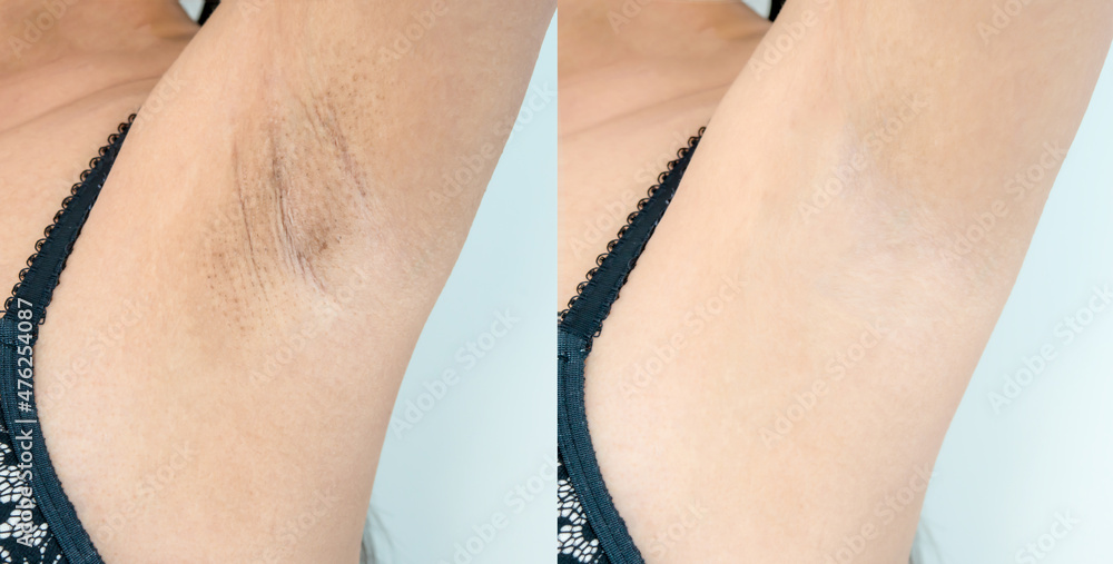 Image before and after skincare cosmetology armpits epilation treatment  concept. Close up underarm skin Problem rough chicken skin, Fox Fordyce,  black armpit in Asian woman. Stock-Foto | Adobe Stock