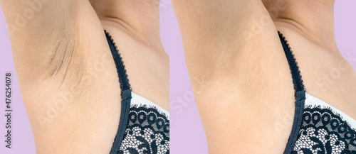 Image before and after skincare cosmetology armpits epilation treatment concept. Close up underarm skin Problem rough chicken skin, Fox Fordyce, black armpit in Asian woman. photo