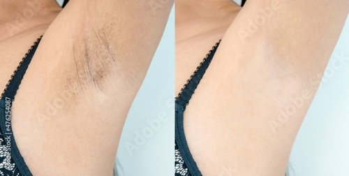 Image before and after skincare cosmetology armpits epilation treatment concept. Close up underarm skin Problem rough chicken skin, Fox Fordyce, black armpit in Asian woman. photo