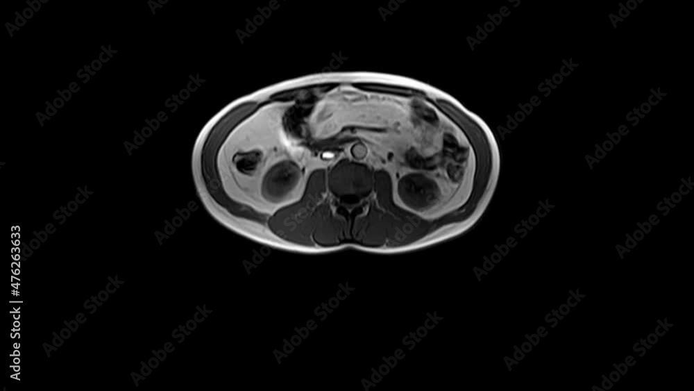 CT scan of the abdomen. Computed tomography of the gastrointestinal tract, liver and kidneys. CT scan of the abdomen. Computed tomography of the gastrointestinal tract, liver and kidneys.