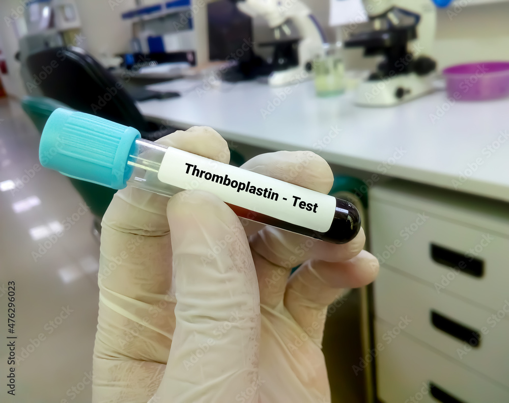 Blood sample for thromboplastin or factor 3 test, diagnosis of coagulation disorder