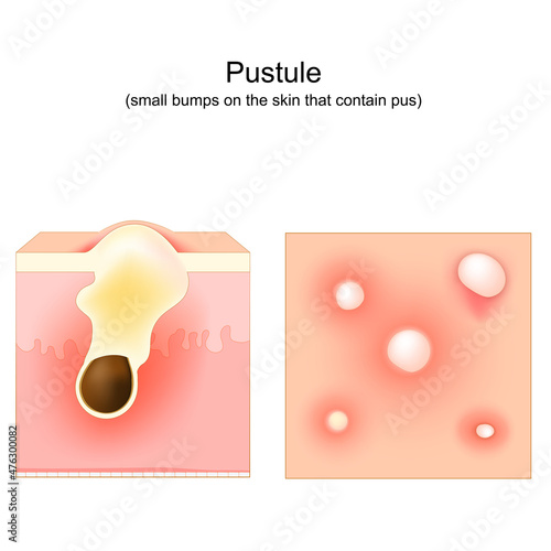 Acne. Pustule. Cross-section of a human skin. Hair follicle with pus.
