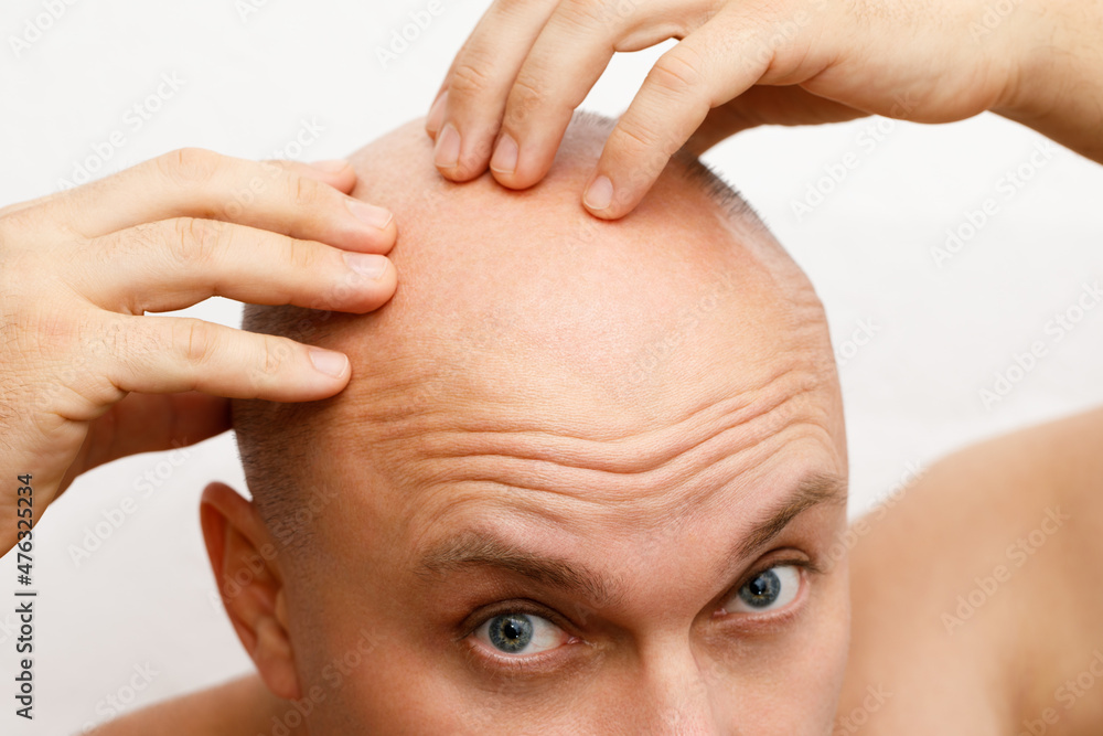 The head of a balding man. A bald man was upset because of the hair loss. Treatment of baldness. The head of a balding man. A bald man was upset because of the hair loss. Treatment of baldness.