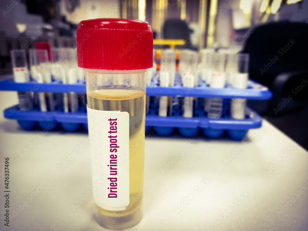 Urine sample for dried urine spot test, urine cortisol test, diagnosis